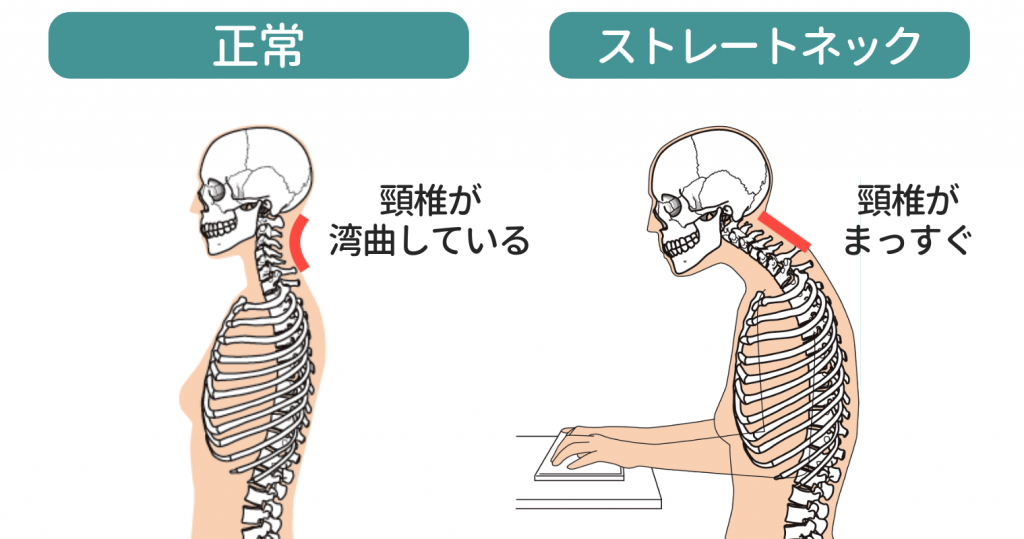 ストレートネックと正常なタイプの違い｜岡山市ジール鍼灸整骨院