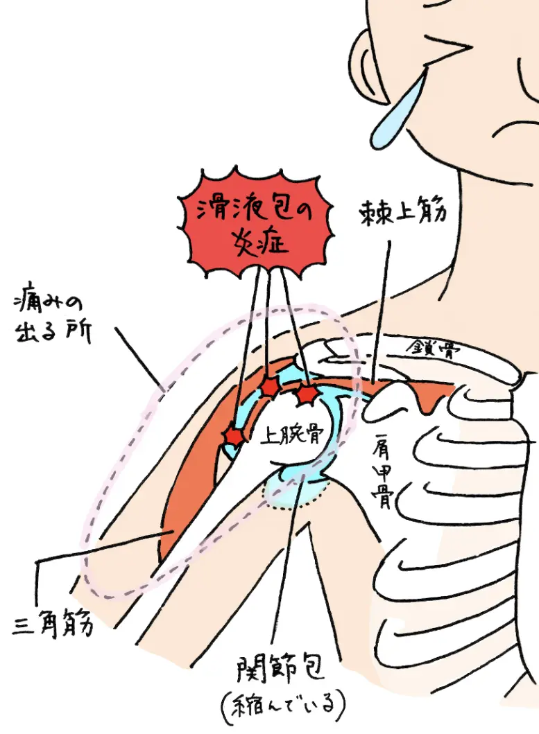 上腕二頭筋長頭腱炎の症状|岡山市南区・中区ジール鍼灸整骨院