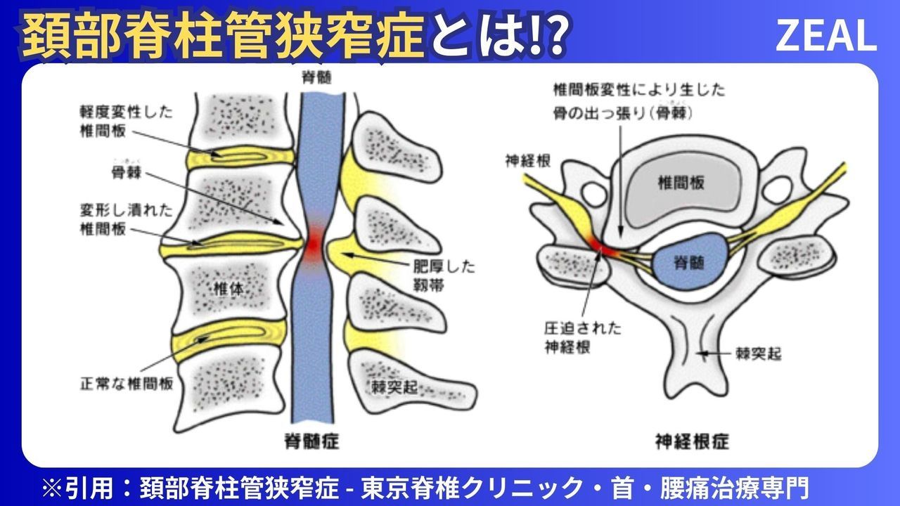 頚部脊柱管狭窄症とは|岡山市南区・中区ジール鍼灸整骨院