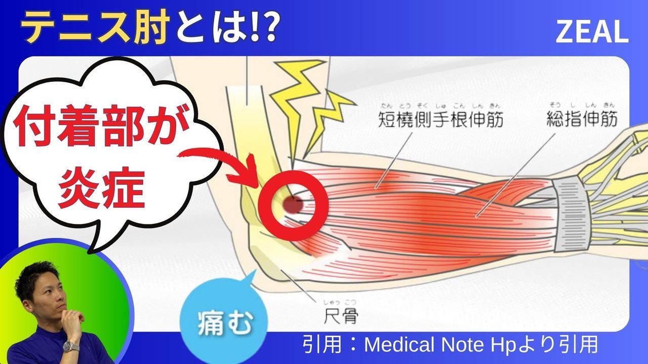 テニス肘とは？|岡山市南区・中区ジール鍼灸整骨院