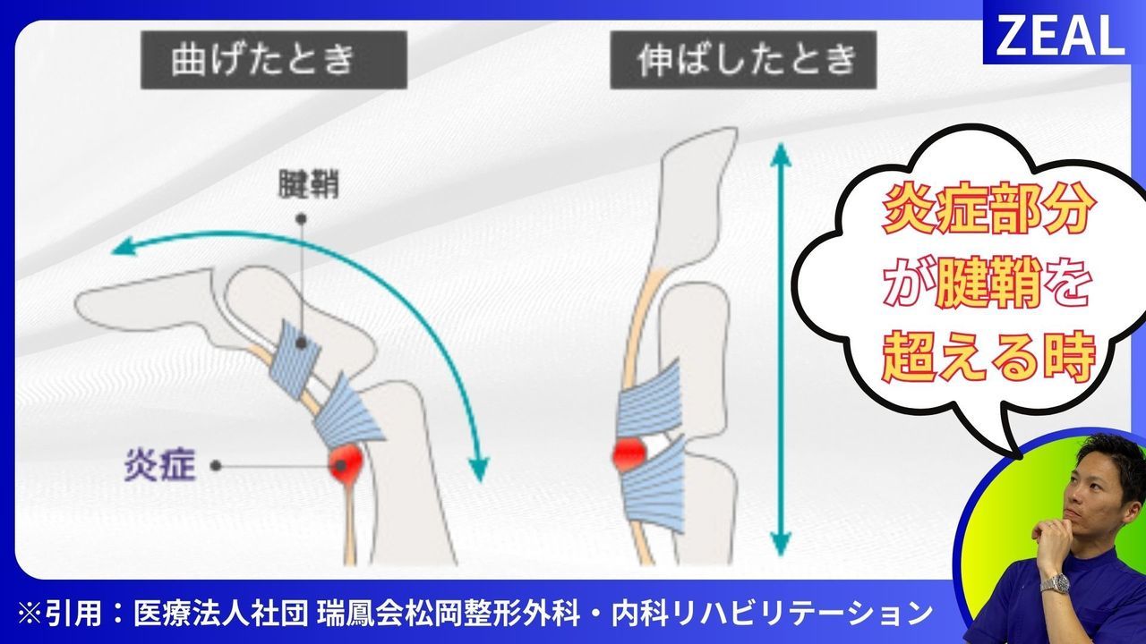 ばね指とは2|岡山市南区・中区ジール鍼灸整骨院