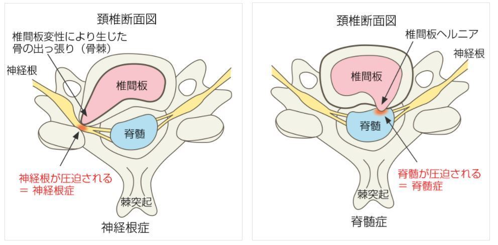 頚椎症とは？|岡山市南区・中区ジール鍼灸整骨院