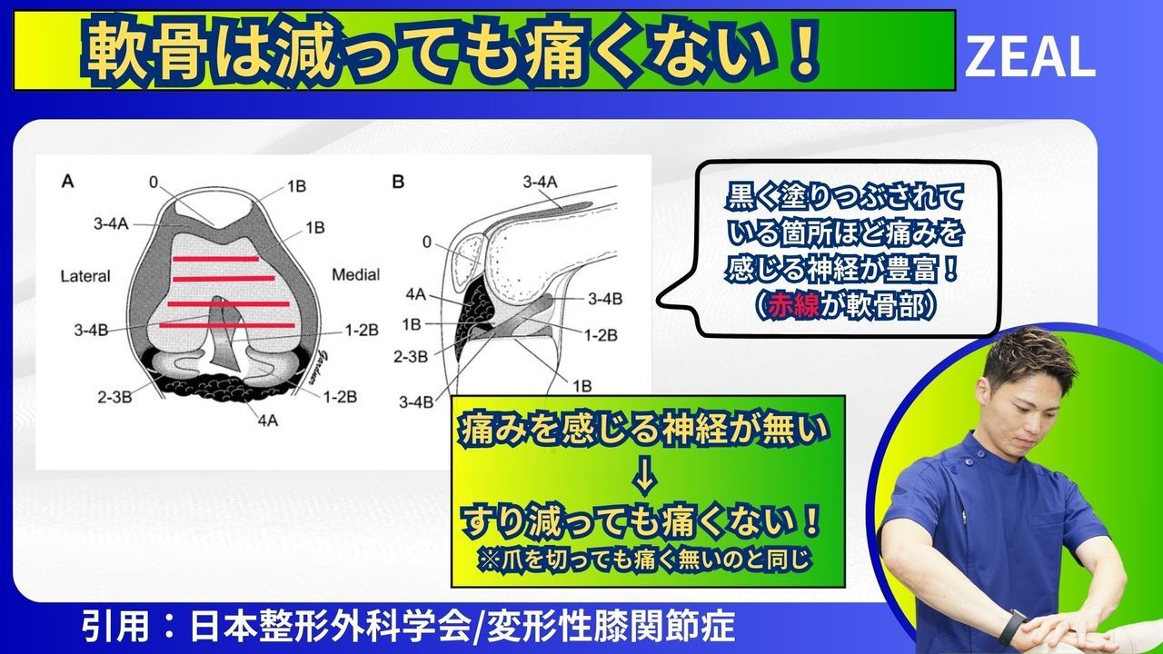 岡山市ジール整骨院|変形性膝関節症とは