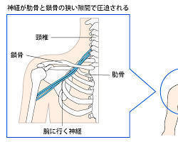 岡山市ジール整骨院|胸郭出口症候群TOS
