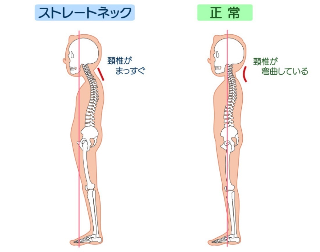 ストレートネックの頸椎湾曲｜岡山市ジール鍼灸整骨院