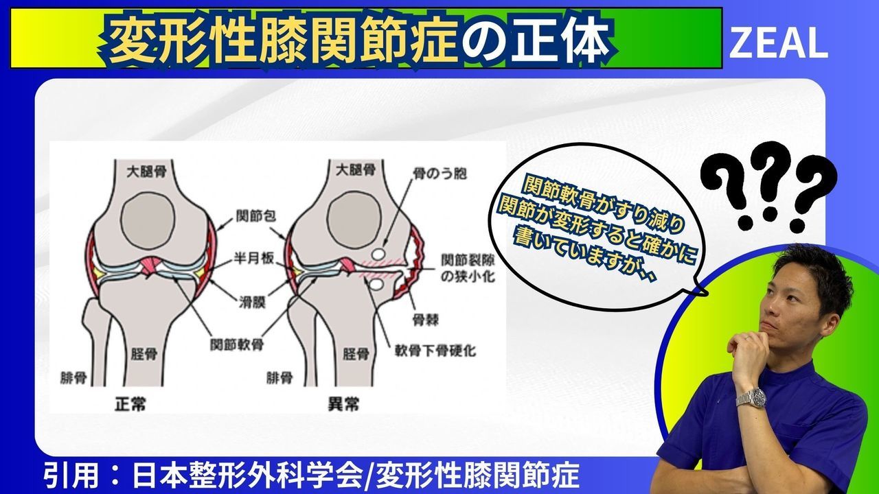 岡山市ジール整骨院|変形性膝関節症とは