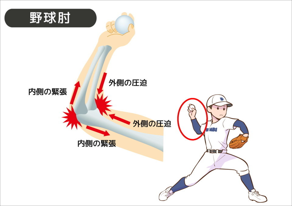 椎間関節性頚部痛の徒手検査|岡山市南区・中区ジール鍼灸整骨院