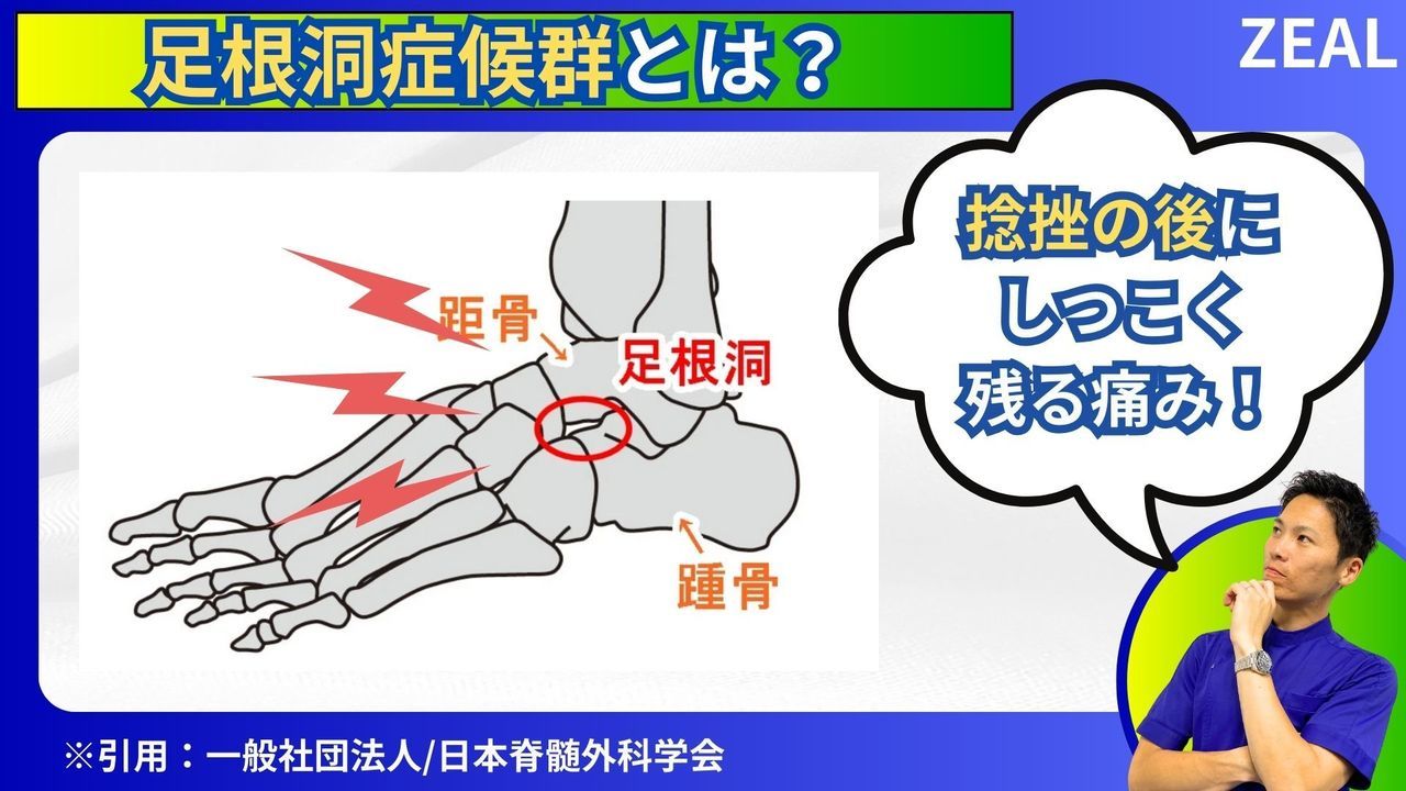 岡山市ジール整骨院|足根洞症候群とは