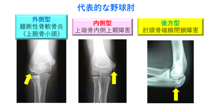 筋筋膜性頚部痛|岡山市南区・中区ジール鍼灸整骨院