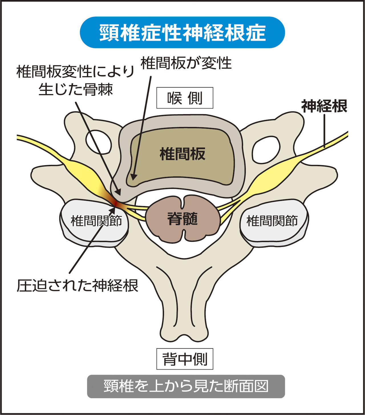 頚椎症の症状|岡山市南区・中区ジール鍼灸整骨院