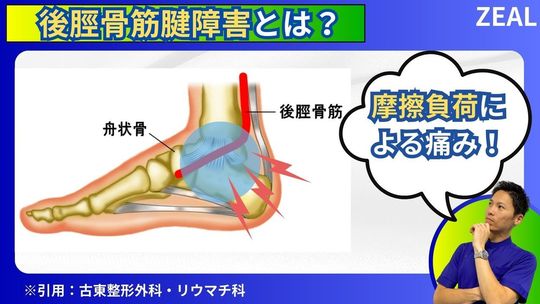 後脛骨筋腱障害 - 岡山市南区・中区ジール鍼灸整骨院｜整体院