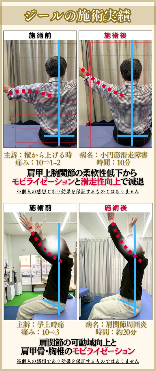 関節の痛み J.McMメンネル著 肩関節インピンジメント症候群 - 岡山市南区・中区ジール鍼灸