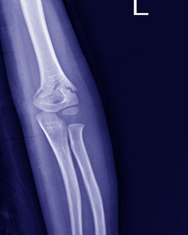 .
こんにちは😄
ジール整骨院です！

本日は上腕骨顆上骨折についてお話します。

上腕骨顆上骨折の症状
・骨折部の痛み
・肘周辺の腫れ
・痛みで腕が動かせない
・肘の上を触ると痛い
・肘に形が左右で違う
・肘ではない部分が動く

上腕骨顆上骨折の症状｜岡山市・倉敷市ジール整骨院
https://zeal-seikotsuin.com/sym/jouwankotsukajoukossetsu/

上腕骨顆上骨折の原因
・肘が反り返った姿勢で手をついて転ける

上腕骨顆上骨折の病態
・骨折した骨が血管や神経を傷つけると、Volkmann(フォルクマン)拘縮と呼ばれる治らない手の変形や神経損傷が発生する。
・骨折部分を適切に固定しないと肘が外側や内側を向いたまま治癒するともある。

#岡山市南区　#岡山市中区　
#岡山市整骨院 　#岡山市ジール整骨院
#岡山市整体　#岡山市交通事故　
#岡山市交通事故治療　#ジール整骨院
#岡山市骨盤矯正　#岡山市整形外科　
#倉敷市整形外科  #倉敷市整骨院　
#倉敷市整体　#倉敷市骨盤矯正
#倉敷市交通事故　#倉敷市交通事故治療　
#倉敷市ジール整骨院  #上腕骨顆上骨折　
#岡山市上腕骨顆上骨折　#倉敷市上腕骨顆上骨折
#肘の痛み　#肘骨折　
#上腕骨顆上骨折リハビリ　#上腕骨顆上骨折原因
#上腕骨顆上骨折子供
